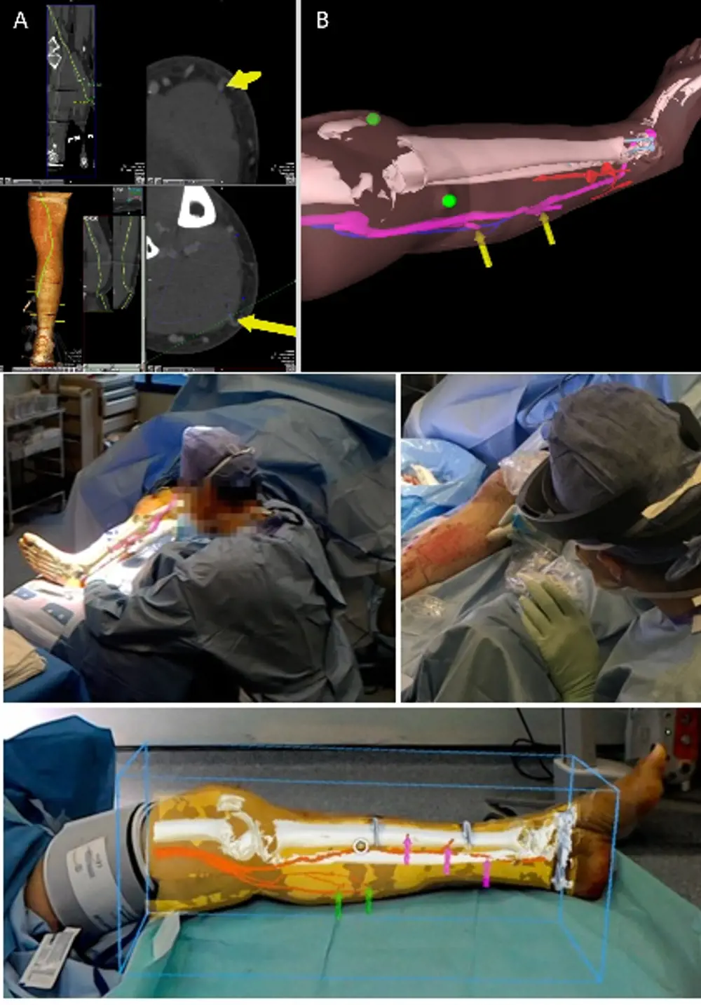 A medical scan with indicated injuries on arm and leg (top). A surgeon using augmented reality headsets from HoloLens that overlay where the injuries are onto the patient in an operating theatre on the arm and leg (middle and bottom).