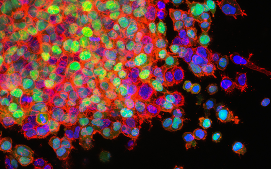 A microscopy image of fluorescently stained cancer cells proliferating in a culture dish.