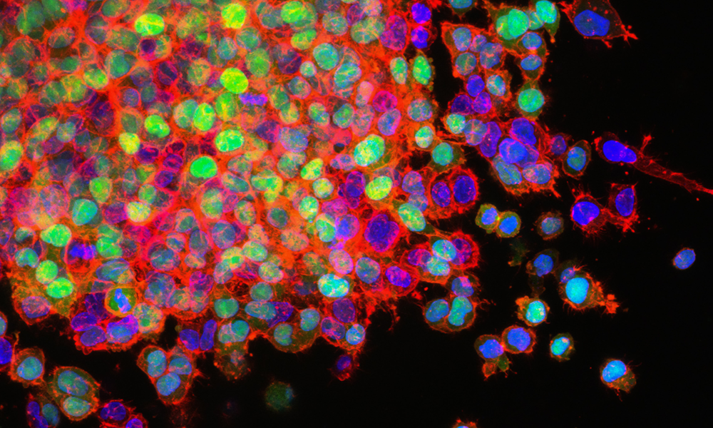 A microscopy image of fluorescently stained cancer cells proliferating in a culture dish.
