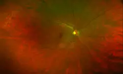 A close-up scan of a healthy retina