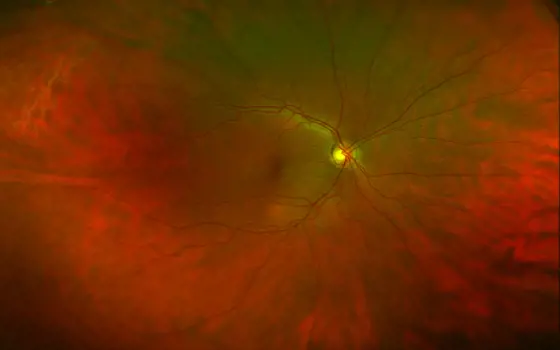 A close-up scan of a healthy retina