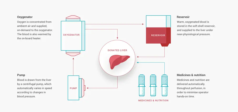 An infographic of how the OrganOx works. The oxygenator receives concentrated oxygen from the air and it supplies warm blood to the donated liver. Blood gets drawn from the liver with a pump that automatically varies in speed according to changes in blood pressure. Medicines and nutrition are delivered automatically.