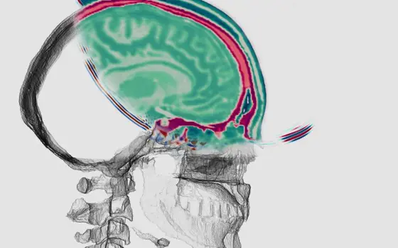 Illustration of a side view of a human head showing a coloured cross‑section of the brain overlaid on a grayscale skull rendering.