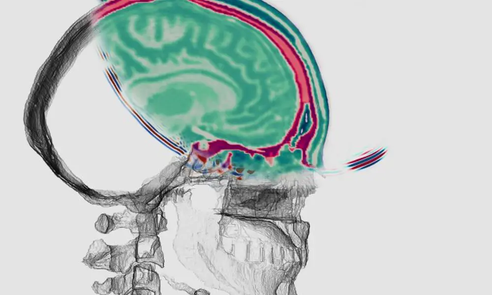 Illustration of a side view of a human head showing a coloured cross‑section of the brain overlaid on a grayscale skull rendering.