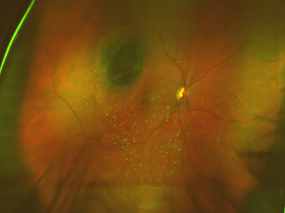 retinal scan showing yellow freckles and tumour